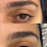 Reconstrução de sobrancelhas